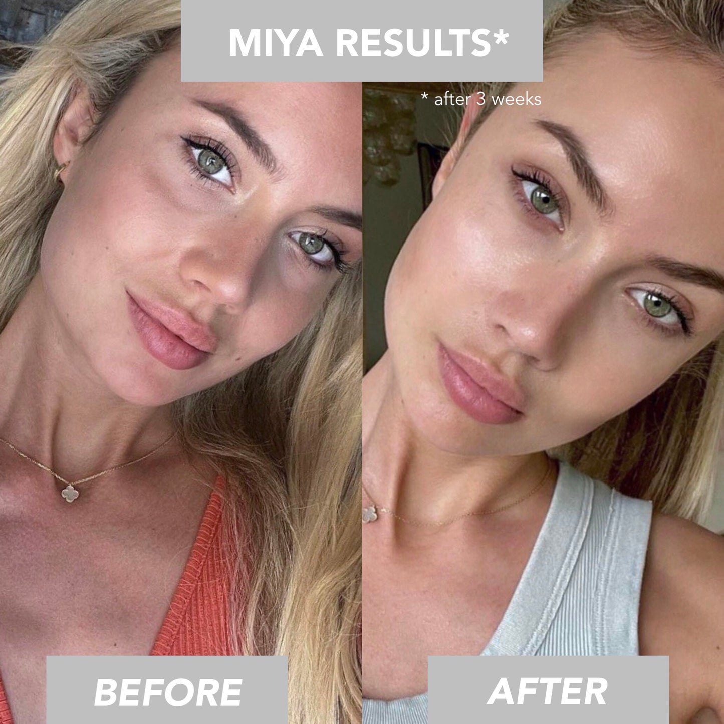 b.elle MIYA Mikrostrom Facelift-Gerät